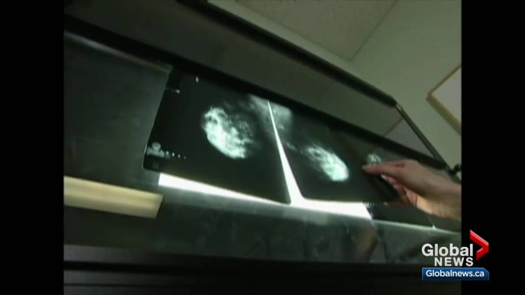 Click to play video: 'Health Matters: Post-vaccine lymph node swelling can be mistaken on mammograms'