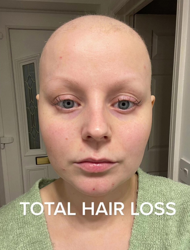 Fallout from the treatment included Jackson losing her hair