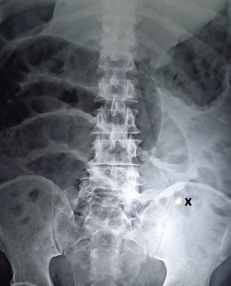 The patient didn't recall swallowing the fish bone.