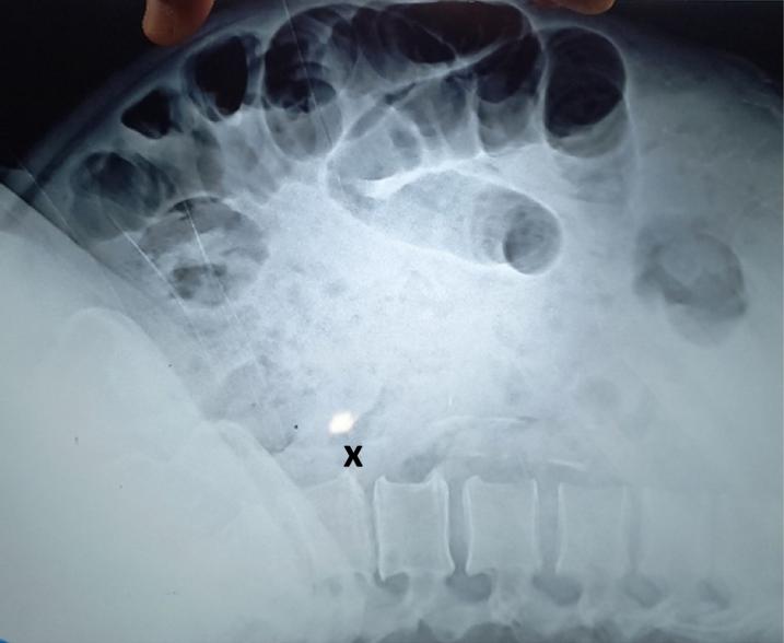 The fish bone had created a small hole in the man's lower intestine.