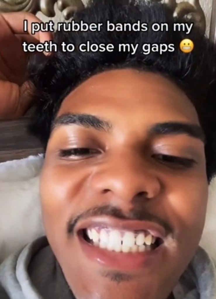 Another dangerous trend is using rubber hair bands to straighten teeth instead of braces.